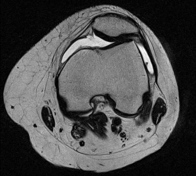 File:Bucket handle tear - medial meniscus (Radiopaedia 79028-91942 Axial T2 19).jpg