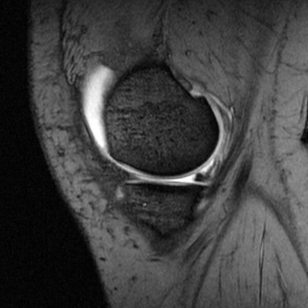 File:Bucket handle tear - medial meniscus (Radiopaedia 79028-91942 D 20).jpg