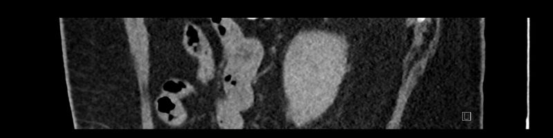 File:Buried bumper syndrome - gastrostomy tube (Radiopaedia 63843-72575 Sagittal Inject 25).jpg