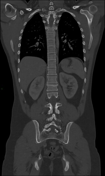 File:Burst fracture (Radiopaedia 83168-97542 Coronal bone window 50).jpg