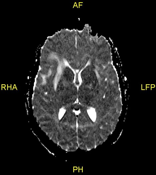 File:Butterfly glioma (Radiopaedia 76707-88526 Axial ADC 14).jpg
