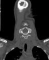 Butterfly vertebra (Radiopaedia 77903-90209 Coronal bone window 14).jpg