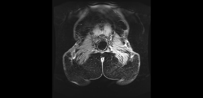 File:Buttock filler complications (Radiopaedia 63497-72115 Coronal T1 C+ 53).jpg