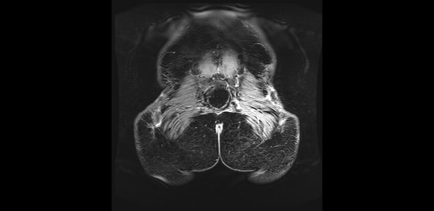 Buttock filler complications (Radiopaedia 63497-72115 Coronal T1 C+ 53).jpg
