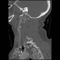 C1 anterior arch (plough) fracture - type 1 (Radiopaedia 76181-87720 Sagittal bone window 35).jpg