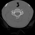 C5 facet fracture (Radiopaedia 58374-65499 Axial bone window 34).jpg
