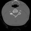 C5 facet fracture (Radiopaedia 58374-65499 Axial bone window 47).jpg