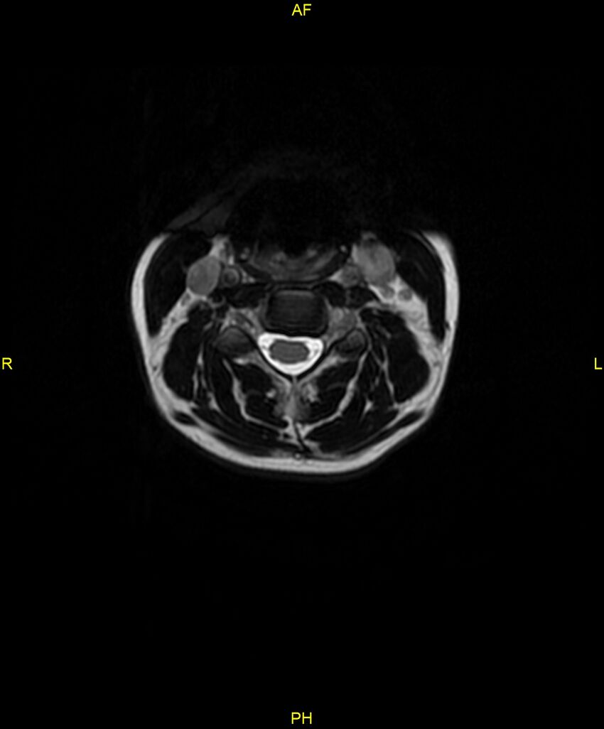 C5 nerve sheath tumor (Radiopaedia 85777-101596 Axial T2 24).jpg