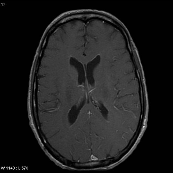 File:CMV ventriculitis and encephalitis (Radiopaedia 5416-7166 Axial T1 C+ 6).jpg