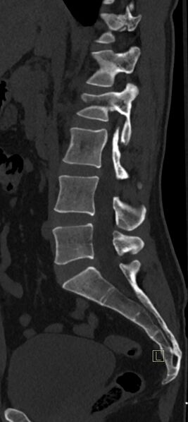 File:Calcaneal fractures with associated L2 burst fracture (Radiopaedia 71671-82493 Sagittal bone window 44).jpg