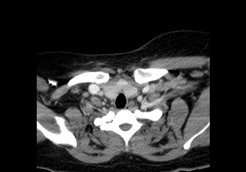 File:Calcific tendinitis of the longus colli muscle (Radiopaedia 28113-28371 B 39).jpg