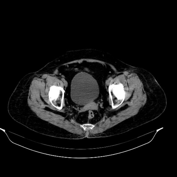 File:Calcified hydatid cyst (Radiopaedia 62000-70085 Axial non-contrast 98).jpg