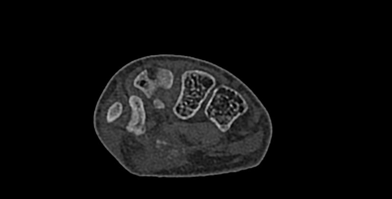 File:Calcifying aponeurotic fibroma (Radiopaedia 88423-105064 Axial bone window 105).jpg
