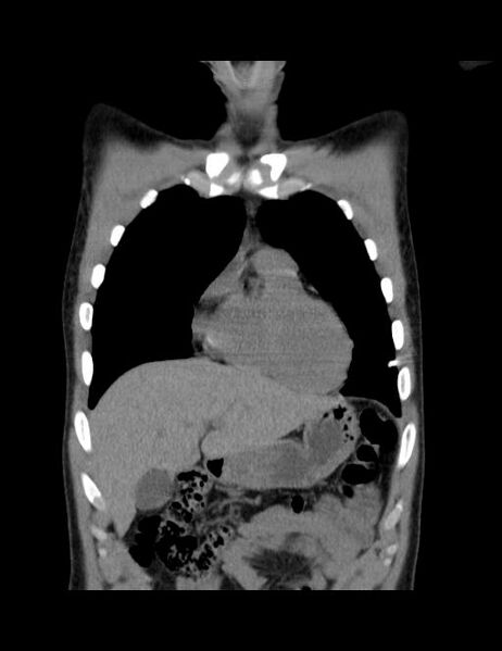 File:Calcifying pulmonary metastases (Radiopaedia 33359-34396 Coronal non-contrast 36).jpg
