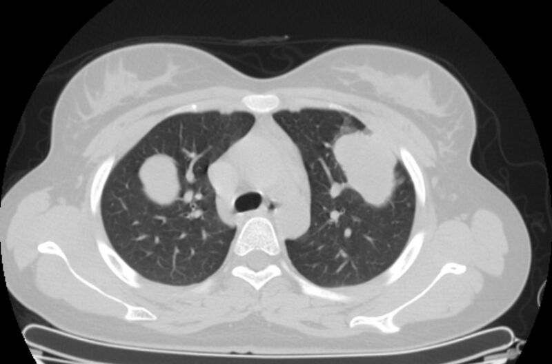 File:Cannonball metastases - uterine choriocarcinoma (Radiopaedia 70137-80173 Axial lung window 22).jpg
