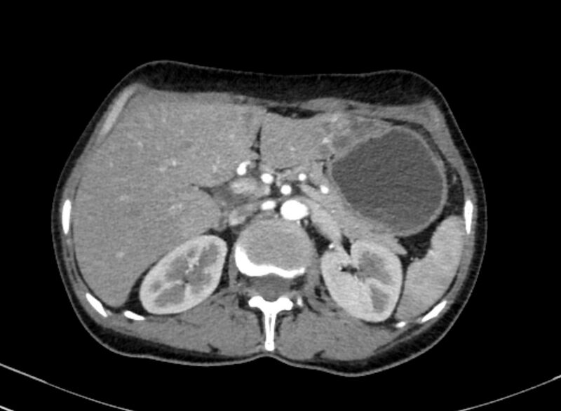 File:Cannonball metastases from breast cancer (Radiopaedia 91024-108569 A 128).jpg