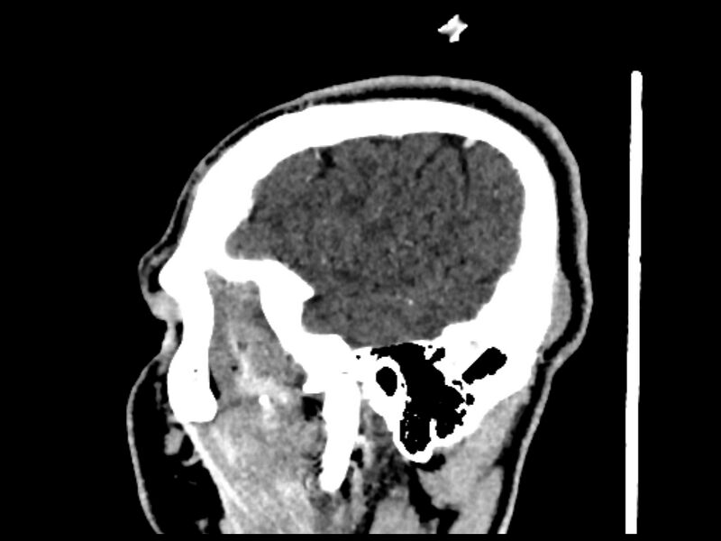File:Capillary hemangioma of the orbit (Radiopaedia 44610-48358 C 7).jpg