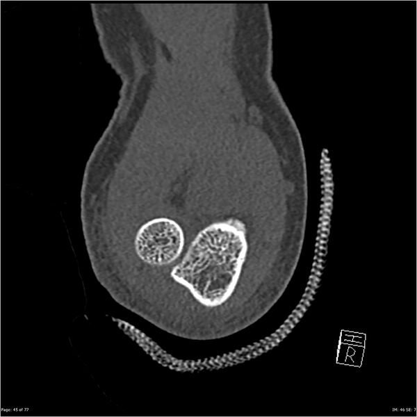 File:Capitellum fracture (Radiopaedia 23352-23426 Coronal bone window 45).jpg