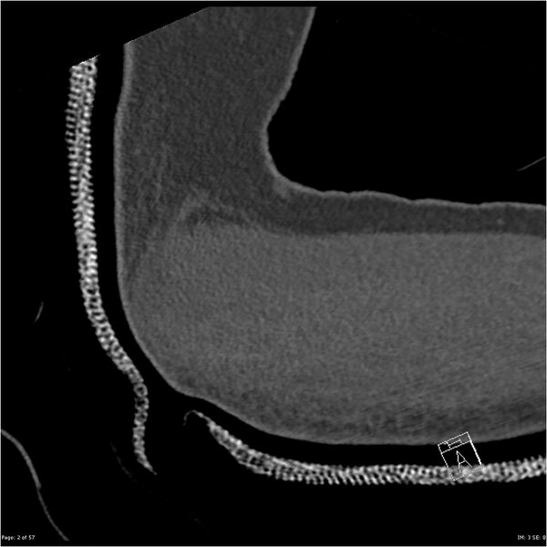 File:Capitellum fracture (Radiopaedia 23352-23426 Sagittal bone window 2).jpg
