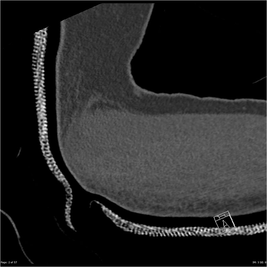 Capitellum fracture (Radiopaedia 23352-23426 Sagittal bone window 2).jpg
