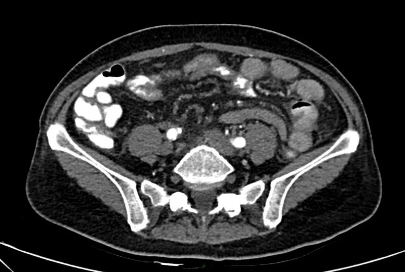 File:Carcinoid mesenteric tumor complicated by chylous ascites (Radiopaedia 76312-88926 A 49).jpg