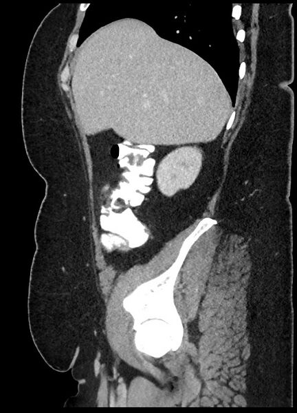File:Carcinoid tumor - terminal ileum (Radiopaedia 60931-68739 C 80).jpg