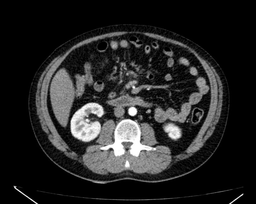 Carcinoid tumor with hepatic metastases (Radiopaedia 22651-22670 B 43).jpg
