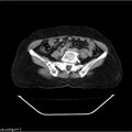 Carcinoma cervix- recurrence (Radiopaedia 34702-36137 B 36).jpg