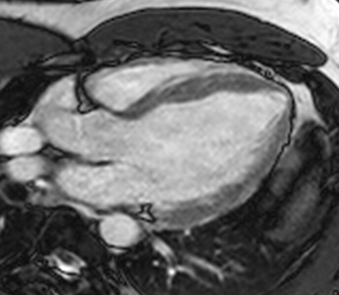 File:Cardiac sarcoidosis (Radiopaedia 39811-42243 LVOT cine images 4).jpg