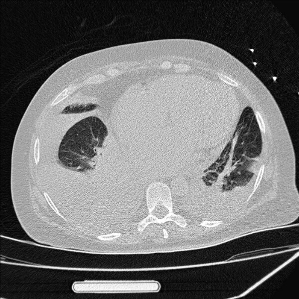 File:Cardiogenic pulmonary edema (Radiopaedia 29213-29609 Axial lung window 72).jpg