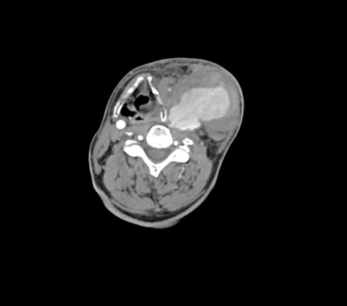 File:Carotid artery pseudoaneurysm (Radiopaedia 84030-99259 C 45).jpg