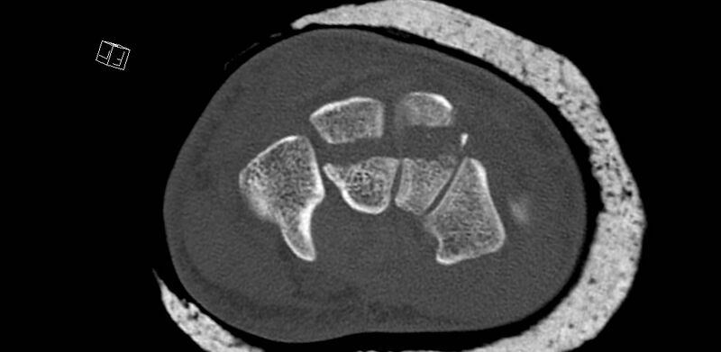 File:Carpal fractures (smart watch impaction) (Radiopaedia 55844-62430 Axial bone window 37).jpg