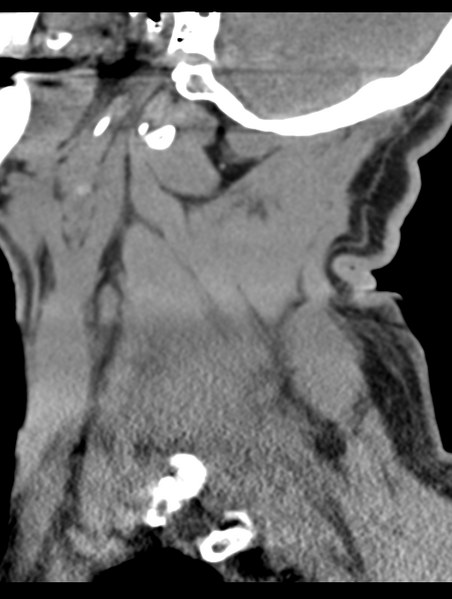 File:Cavernoma of cervical cord (Radiopaedia 50838-56346 B 17).png