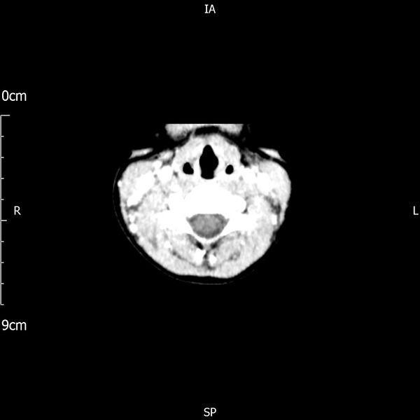 File:Cavernous sinus thrombosis (Radiopaedia 79414-92510 Axial Brain 4).jpg