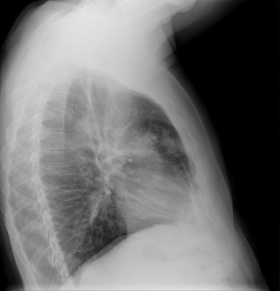 File:Cavitating pneumonia complicated by pneumothorax (Radiopaedia 48149-52992 Lateral 1).png