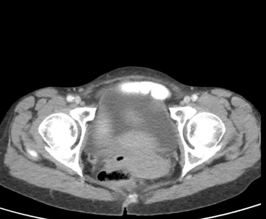 Cecal volvulus with pneumatosis coli (Radiopaedia 68572-78178 A 118).jpg
