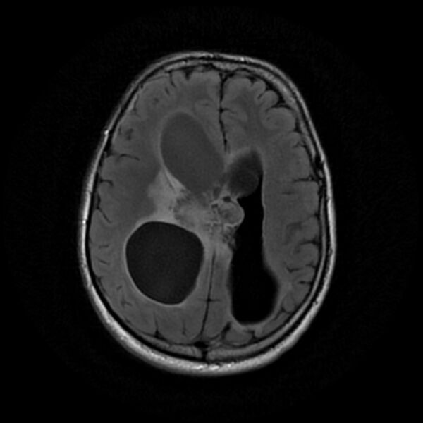 File:Central neurocytoma (Radiopaedia 67618-77021 Axial FLAIR 17).jpg
