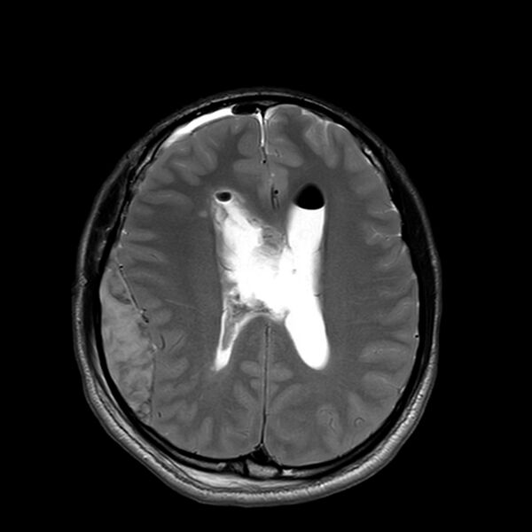 File:Central neurocytoma (Radiopaedia 79320-92381 Axial T2 17).jpg