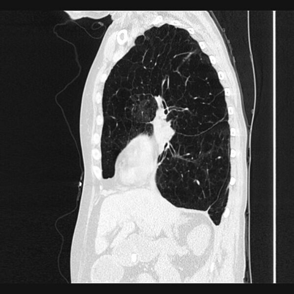 File:Centrilobular pulmonary emphysema (Radiopaedia 24495-24789 Sagittal lung window 32).jpg