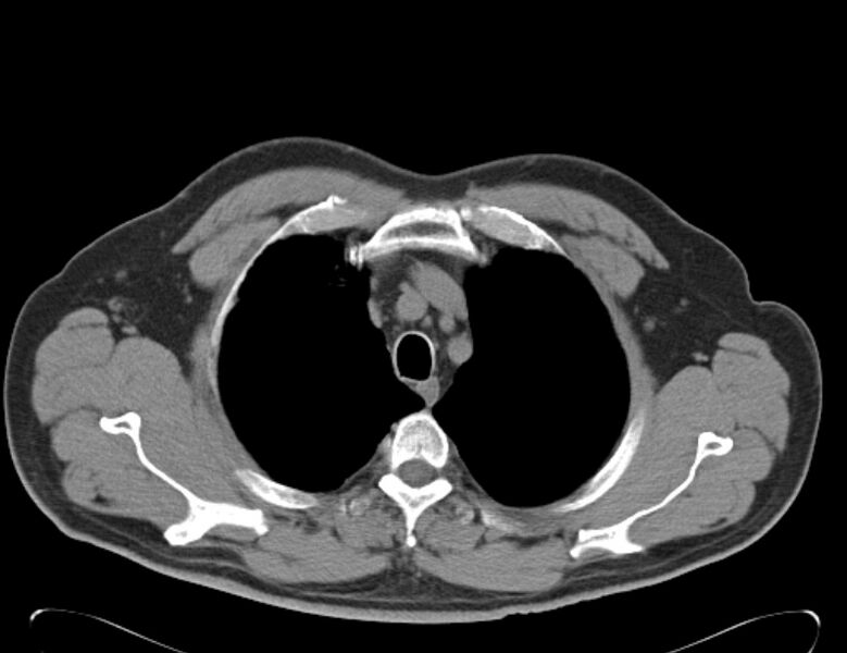 File:Centrilobular pulmonary emphysema (Radiopaedia 26808-26971 Axial non-contrast 7).jpg