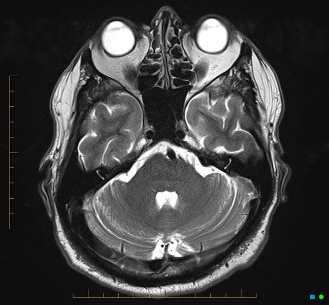File:Cerebellar gangliocytoma (Radiopaedia 65377-74422 Axial T2 10).jpg