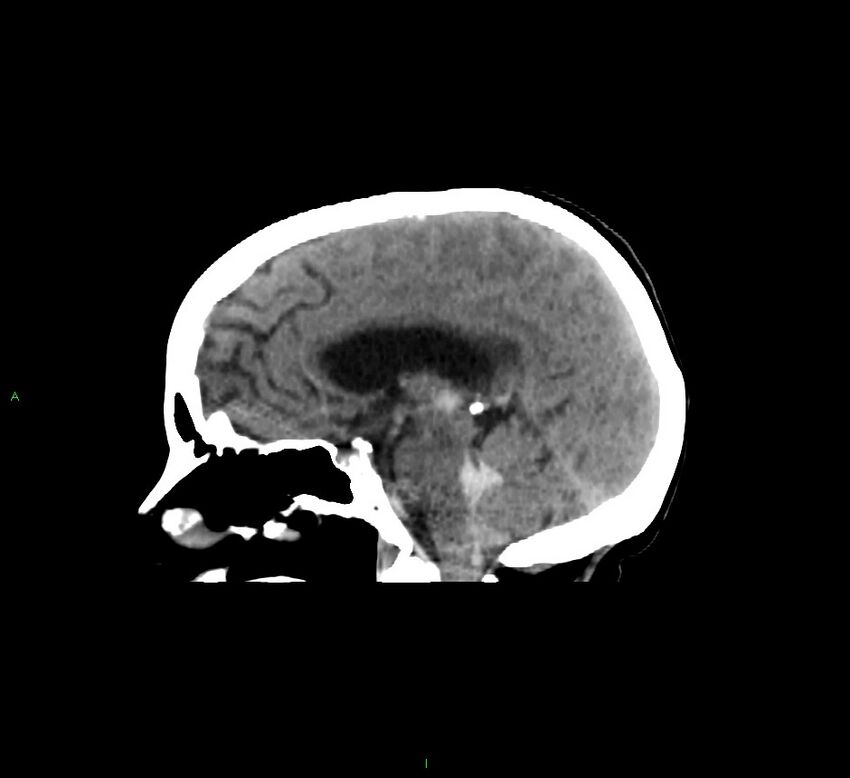 Cerebellar hemorrhage (Radiopaedia 58793-66027 C 28).jpg