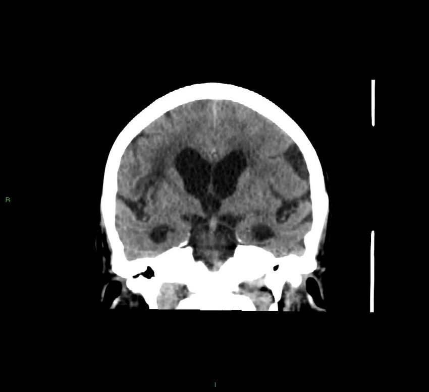 Cerebellar hemorrhage (Radiopaedia 58793-66027 Coronal non-contrast 39).jpg