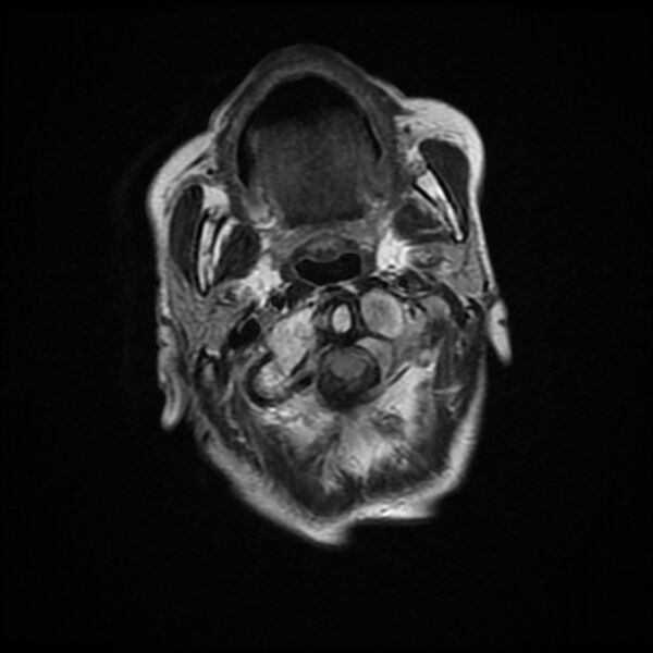 File:Cerebellar metastasis - lung tumor (Radiopaedia 69317-79147 Axial FLAIR 21).jpg