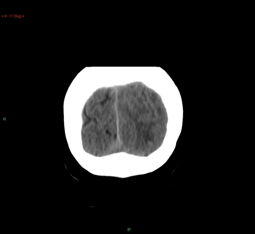 Cerebral amyloid angiopathy-associated lobar intracerebral hemorrhage (Radiopaedia 58378-65518 Coronal non-contrast 17).jpg