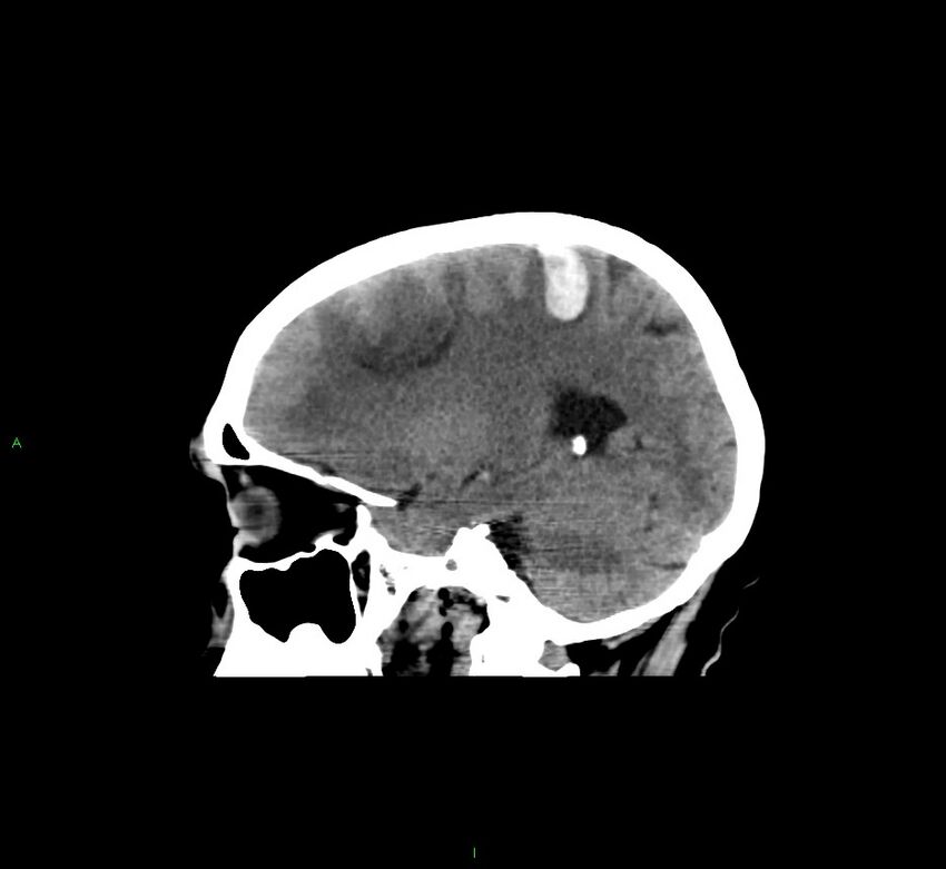 Cerebral amyloid angiopathy-associated lobar intracerebral hemorrhage (Radiopaedia 58529-65681 B 32).jpg