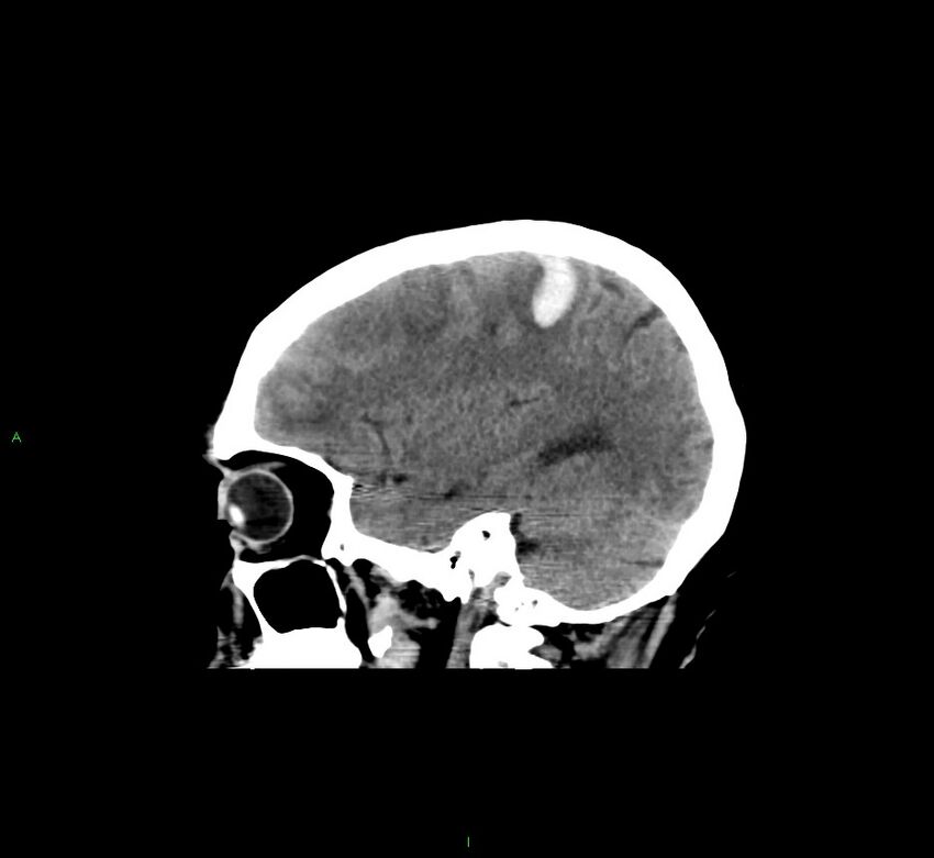Cerebral amyloid angiopathy-associated lobar intracerebral hemorrhage (Radiopaedia 58529-65681 B 35).jpg