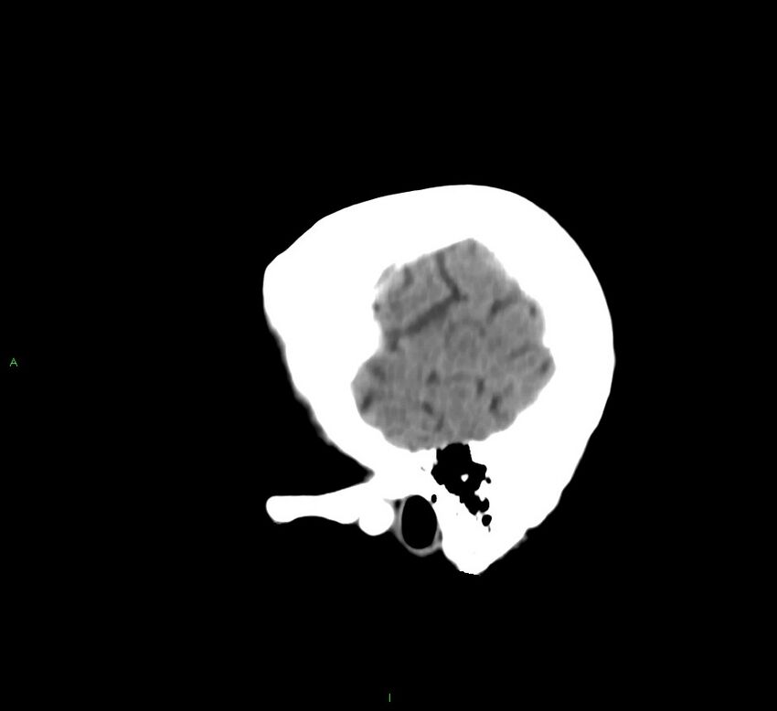 Cerebral amyloid angiopathy-associated lobar intracerebral hemorrhage (Radiopaedia 58530-65688 C 48).jpg