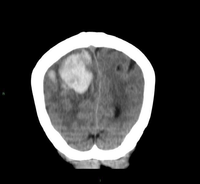 File:Cerebral amyloid angiopathy-associated lobar intracerebral hemorrhage (Radiopaedia 58751-65972 Coronal non-contrast 13).jpg