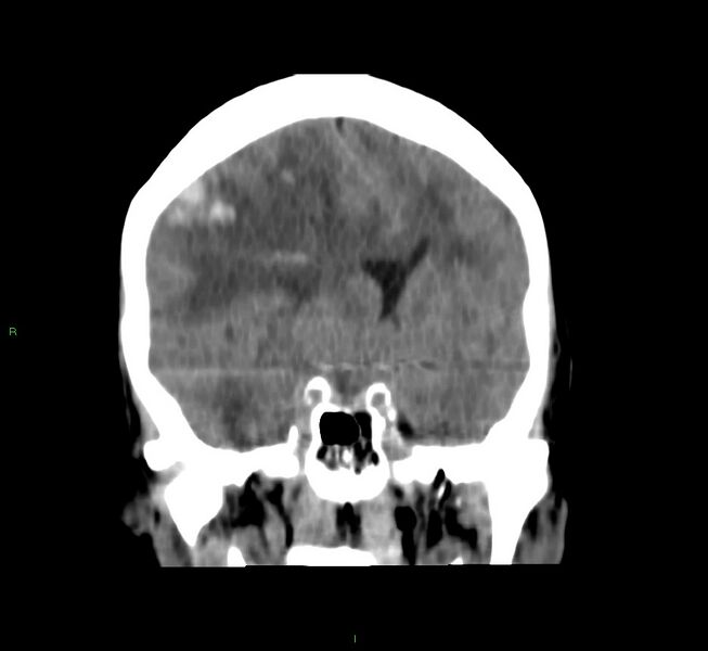 File:Cerebral amyloid angiopathy-associated lobar intracerebral hemorrhage (Radiopaedia 58751-65972 Coronal non-contrast 37).jpg